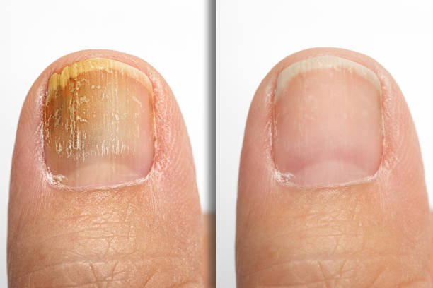 Before and after nail improvement for women